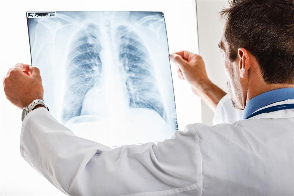 Akciğer kanserinde pasif içicilik göz ardı edilmemeli #2