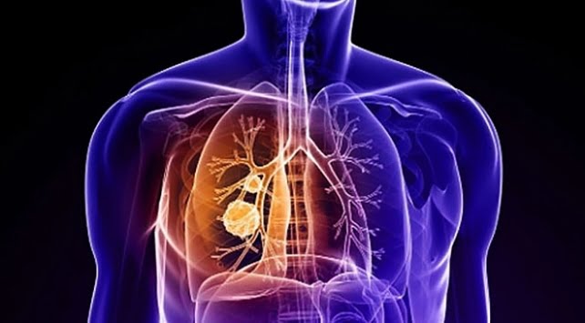 Akciğer kanseriyle nasıl savaşmalıyız #1