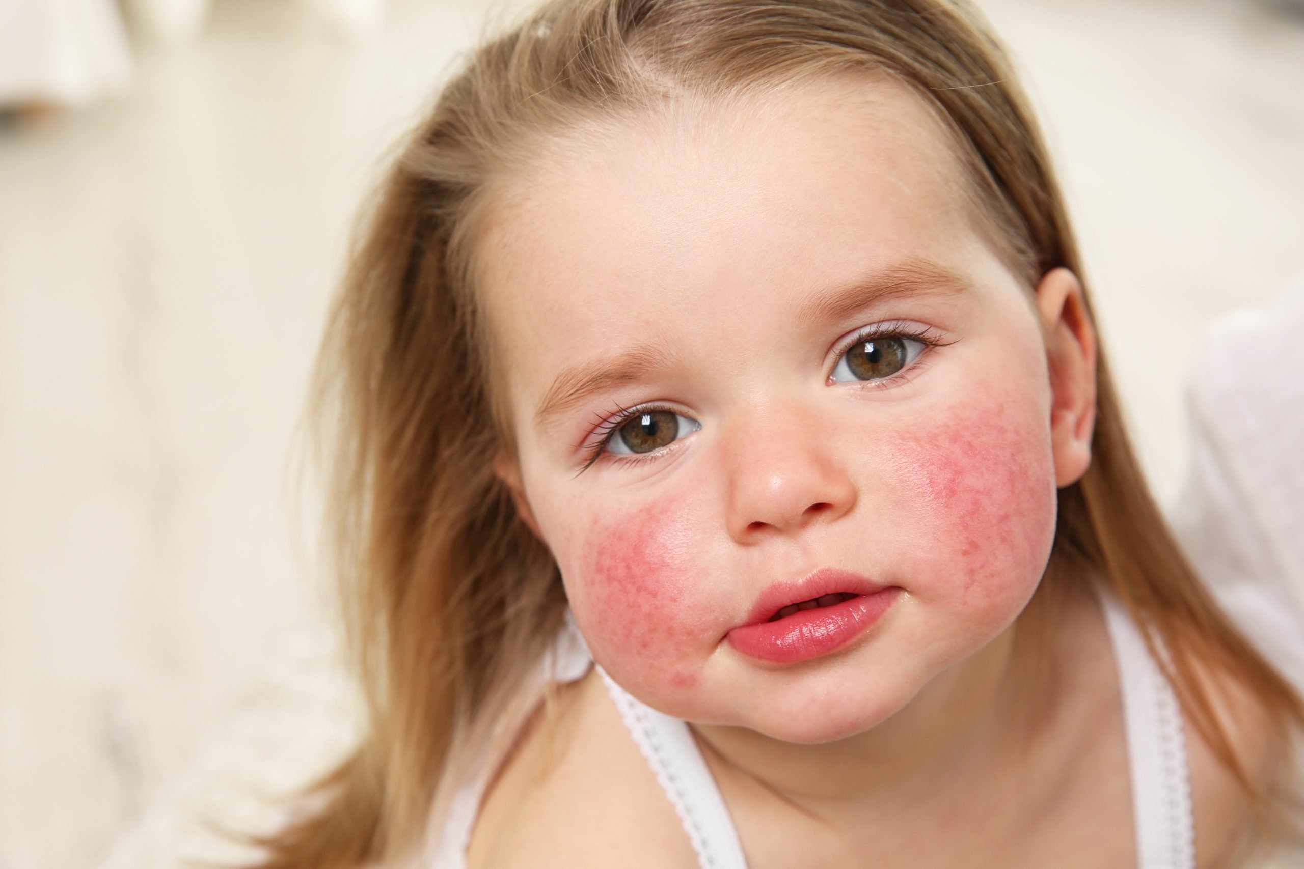 Çocuklarda besin alerjileri 3 kat arttı #2