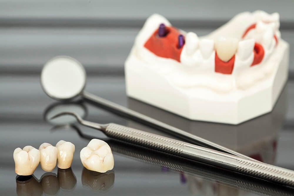 Kırık diş tedavi edilmezse apseye davetiye çıkarabilir #1