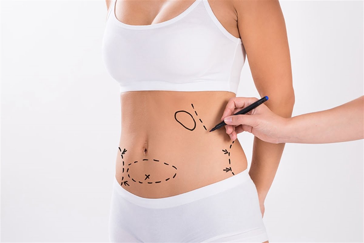 Liposuction uygulaması nedir? #1